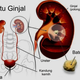 Illustration for article titled obat batu ginjal de natureem/em